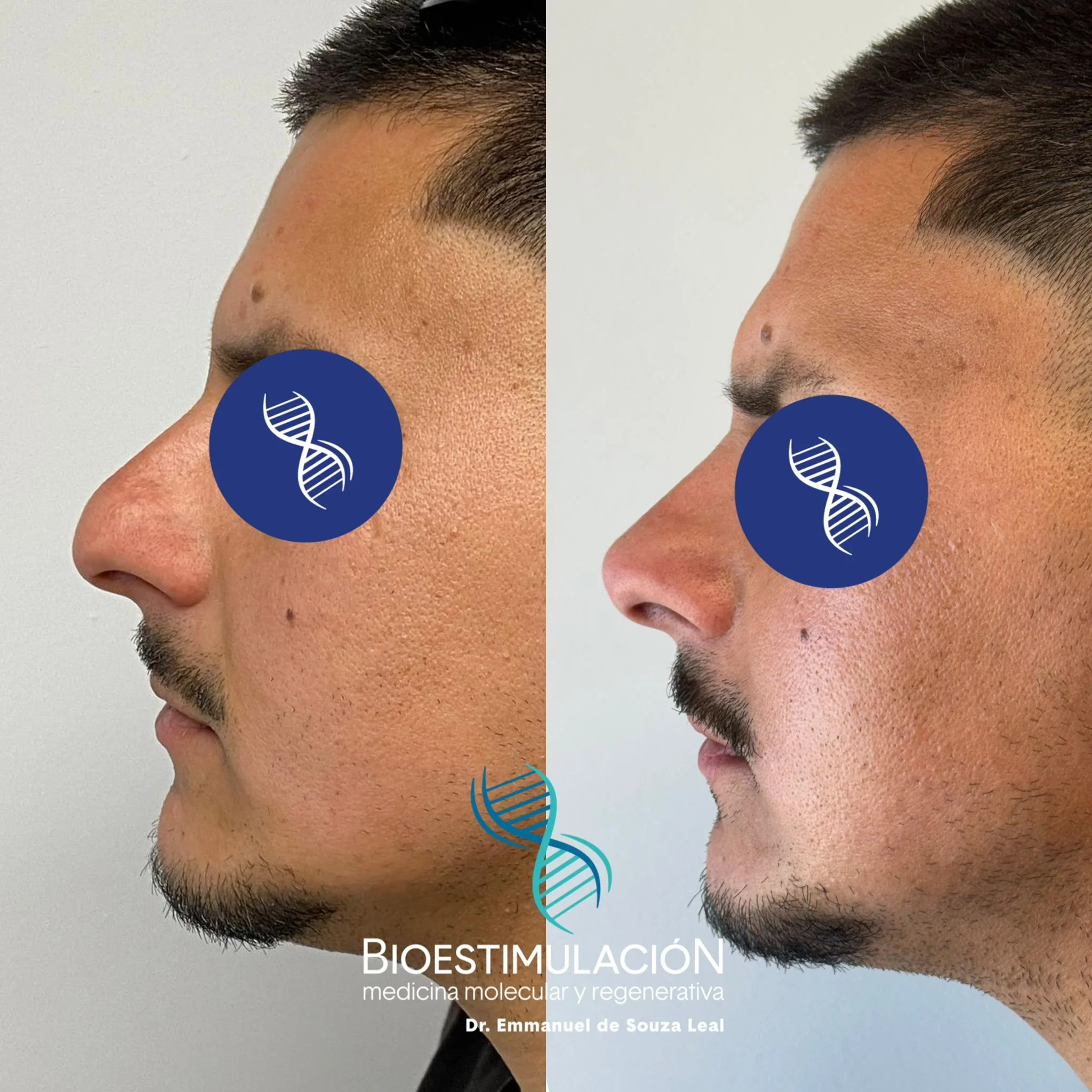 Resultado de tratamiento capilar en Montevideo – Bioestimulación